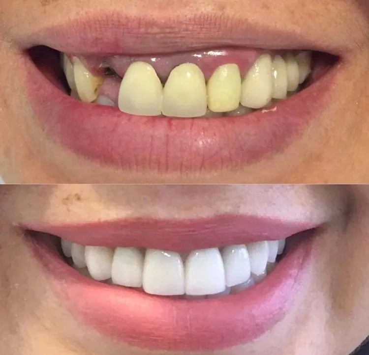 Antes e depois de implante dentário