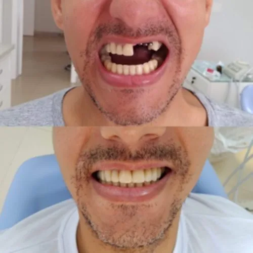 Antes e depois de implante dentário