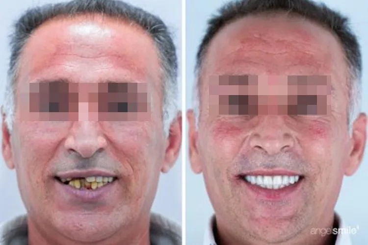 Antes e depois de implante dentário