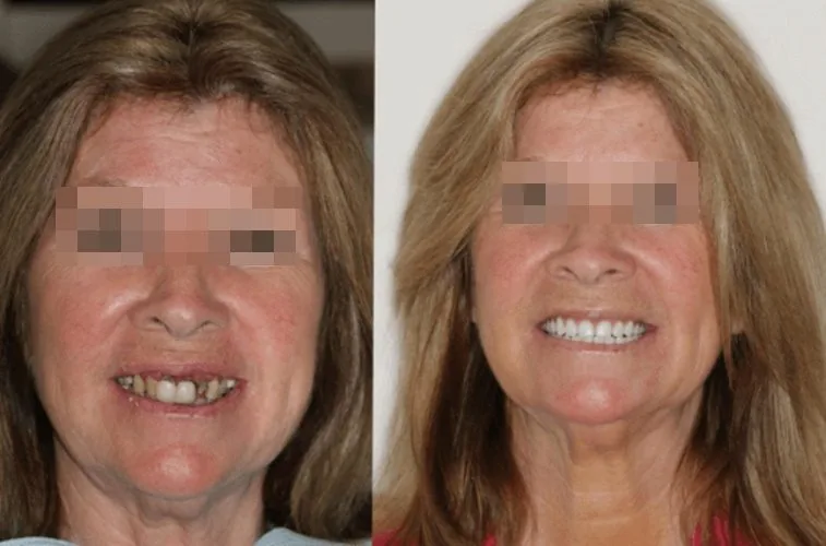 Antes e depois de implante dentário
