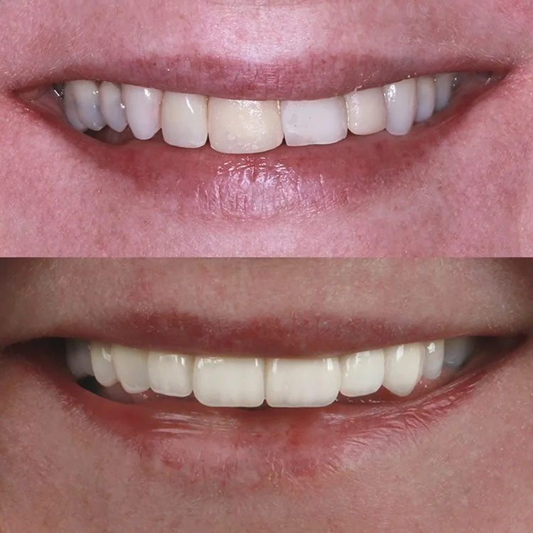 Antes e depois de implante dentário