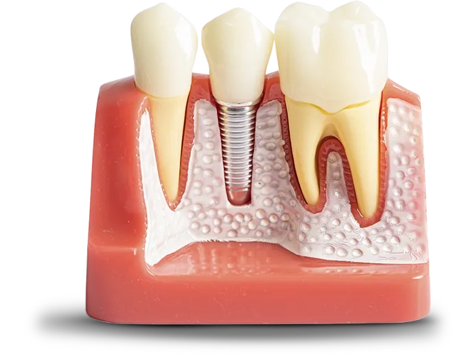 Implante Dentário