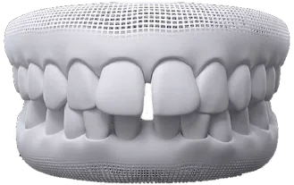Diastema