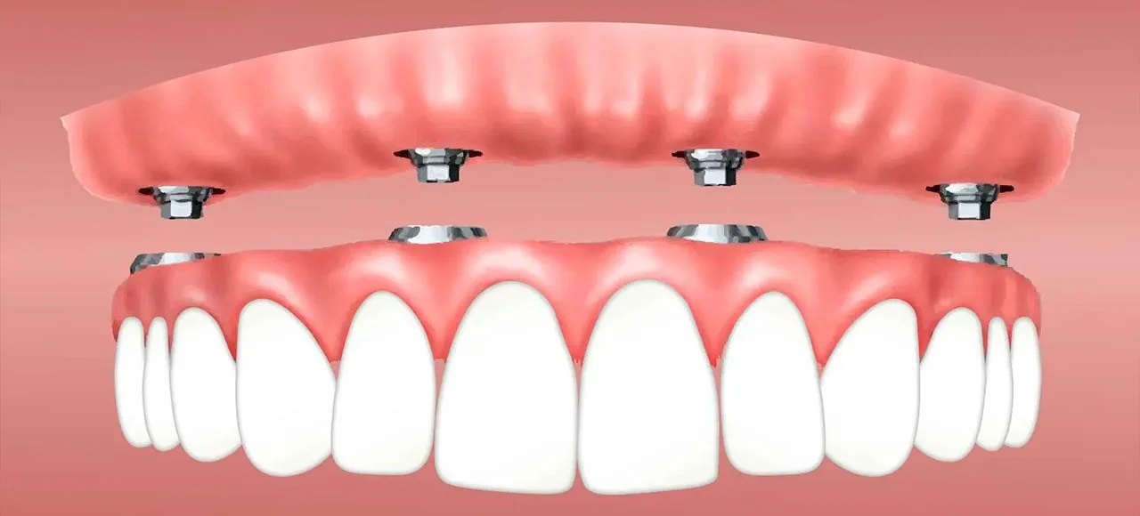 Prótese Dentária